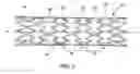 Fig. 05 - Flexible stretch stent-graft