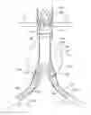 Fig. 01 - Bifurcated endovascular prosthesis having tethered contralateral leg