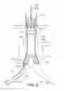 Fig. 05 - Bifurcated endovascular prosthesis having tethered contralateral leg