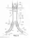 Fig. 06 - Bifurcated endovascular prosthesis having tethered contralateral leg