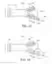 Fig. 12 - Bifurcated endovascular prosthesis having tethered contralateral leg