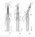Fig. 06 - Transosseous suture anchor method