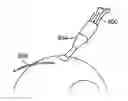 Fig. 01 - Scleral prosthesis for treating presbyopia and other eye disorders and related devices and methods