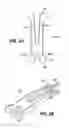Fig. 03 - Scleral prosthesis for treating presbyopia and other eye disorders and related devices and methods