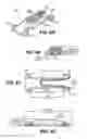 Fig. 08 - Scleral prosthesis for treating presbyopia and other eye disorders and related devices and methods