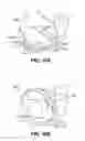 Fig. 15 - Scleral prosthesis for treating presbyopia and other eye disorders and related devices and methods
