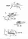 Fig. 06 - Scleral prosthesis for treating presbyopia and other eye disorders and related devices and methods