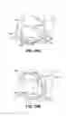 Fig. 15 - Scleral prosthesis for treating presbyopia and other eye disorders and related devices and methods