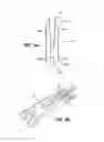 Fig. 03 - Scleral prosthesis for treating presbyopia and other eye disorders and related devices and methods