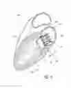 Fig. 04 - Vascular implant and delivery system