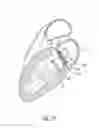 Fig. 37 - Vascular implant and delivery system