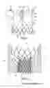 Fig. 06 - Heart valve prosthesis and methods of manufacture and use