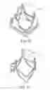 Fig. 07 - REPLACEMENT PROSTHETIC HEART VALVES AND METHODS OF IMPLANTATION