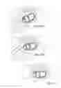 Fig. 17 - Method of retroperitoneal lateral insertion of spinal implants