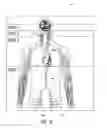 Fig. 19 - Delivery of medical devices