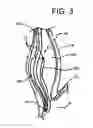 Fig. 04 - Support device for gastrointestinal implant