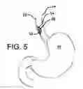 Fig. 06 - Support device for gastrointestinal implant