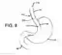 Fig. 09 - Support device for gastrointestinal implant
