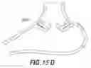 Fig. 18 - Systems and methods related to gastro-esophageal implants