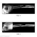 Fig. 05 - System for neuroprotective therapy for glaucoma
