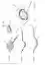 Fig. 75 - Apparatuses and methods for negative pressure wound therapy