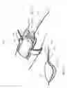 Fig. 79 - Apparatuses and methods for negative pressure wound therapy