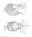 Fig. 17 - Oral mouthpiece and method for the use thereof