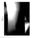 Fig. 04 - METHOD FOR TREATING ITCHING