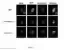 Fig. 03 - Treatment of myotonic dystrophy