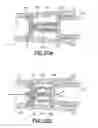 Fig. 19 - Multi-use blood control safety catheter assembly