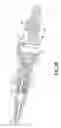Fig. 41 - Needle capture safety interlock for catheter