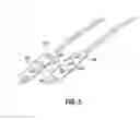 Fig. 04 - Spinal cord stimulation with interferential current