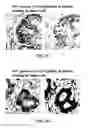 Fig. 08 - G-Alpha Interacting Vesicle Associated Protein (GIV) as a Predictive Marker in Stage II Colorectal Cancer