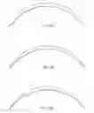 Fig. 41 - CONTACT LENSES FOR REFRACTIVE CORRECTION