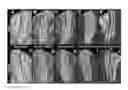 Fig. 01 - Quantitating disease progression from the MRI images of multiple sclerosis patients