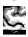 Fig. 04 - Quantitating disease progression from the MRI images of multiple sclerosis patients