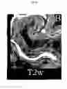 Fig. 05 - Quantitating disease progression from the MRI images of multiple sclerosis patients