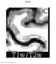 Fig. 06 - Quantitating disease progression from the MRI images of multiple sclerosis patients