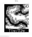 Fig. 07 - Quantitating disease progression from the MRI images of multiple sclerosis patients