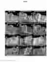 Fig. 16 - Quantitating disease progression from the MRI images of multiple sclerosis patients