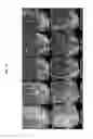 Fig. 19 - Quantitating disease progression from the MRI images of multiple sclerosis patients