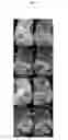 Fig. 20 - Quantitating disease progression from the MRI images of multiple sclerosis patients