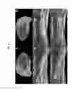 Fig. 23 - Quantitating disease progression from the MRI images of multiple sclerosis patients