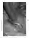 Fig. 06 - Method and apparatus for identifying the ureter during a minimally-invasive procedure