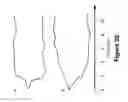 Fig. 38 - Algorithms for gait measurement with 3-axes accelerometer/gyro in mobile devices