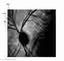 Fig. 01 - Method for detecting a disease by analysis of retinal vasculature