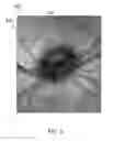 Fig. 04 - Method for detecting a disease by analysis of retinal vasculature