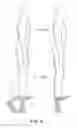Fig. 08 - Feedback method and wearable device to monitor and modulate knee adduction moment