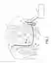 Fig. 02 - Detection of medical electrical lead issues
