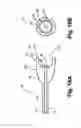 Fig. 22 - Minimally invasive methods and apparatus